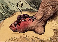 Gout, a 1799 caricature by James Gillray
