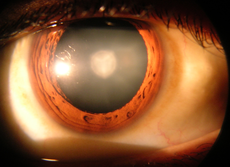 Magnified view of cataract in human eye, seen on examination with a slit lamp using diffuse illumination