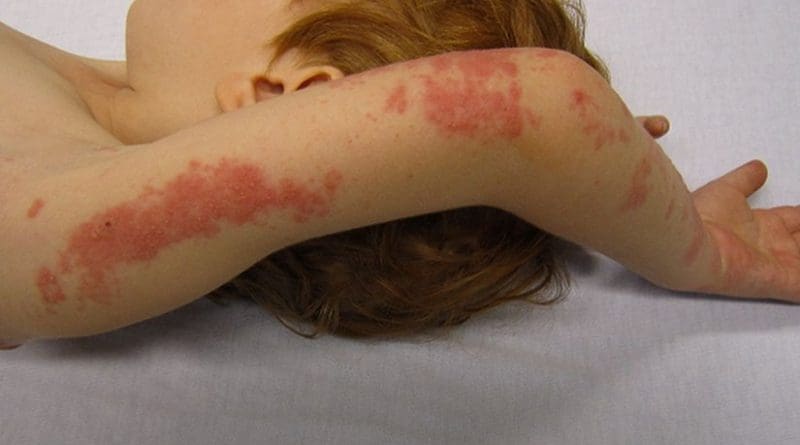 A child with a case of shingles in the C8/T1 dermatone. Photo by James Heilman, MD, Wikipedia Commons.