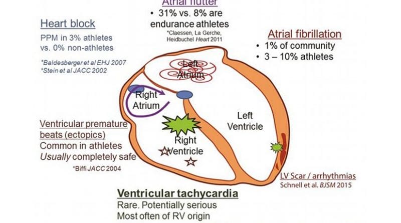 Increased incidence of arrhythmias in the athlete’s heart. There is a well demonstrated association between atrial fibrillation and/or flutter and endurance exercise training. There is also an increase in premature ventricular beats, although this tends to be benign in most athletes. Although there is some speculation that extreme exercise might cause serious arrhythmias in some cases, these events remain very uncommon. PPM, permanent pacemaker; RV, right ventricular.