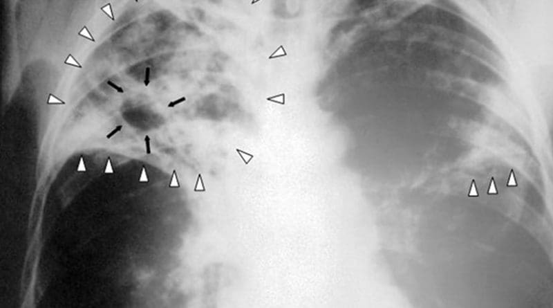 Chest X-ray of a person with advanced tuberculosis. Photo Credit: Centers for Disease Control and Prevention, Wikipedia Commons.