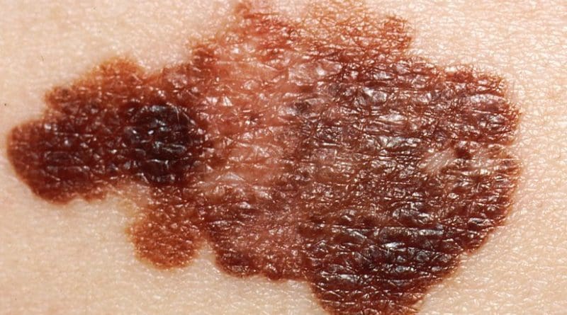 Melanoma. Photo Credit: National Cancer Institute, Wikipedia Commons.