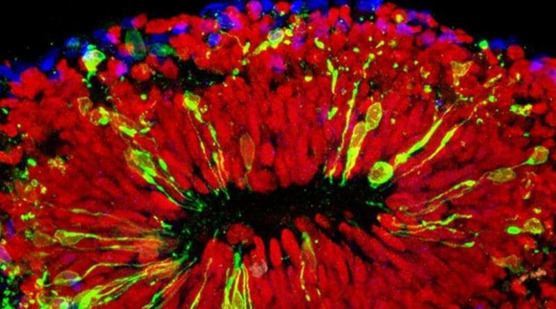 This is a mini-brain infected with Zika virus. The virus is shown in green, vulnerable neural progenitor cells are shown in red, and neurons are shown in blue. Credit Xuyu Qian/Johns Hopkins Medicine