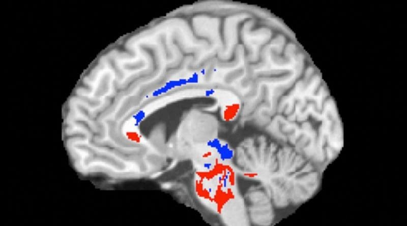 This image of a concussion patient's brain shows low FA areas (red) probably signifying injured white matter, plus high FA areas (blue) perhaps indicating more efficient white-matter connections compensating for concussion damage. A large amount of high FA predicts recovery from concussion. Credit Photo reproduced from Strauss SB, Kim N, Branch CA. Bidirectional Changes in Anisotropy Are Associated with Outcomes in Mild Traumatic Brain Injury. AJNR Am J Neuroradiol 2016 Jun 9.