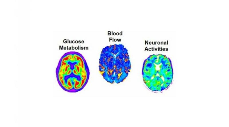 his study used multiple imaging techniques to measure amyloid concentration, glucose metabolism, cerebral blood flow, functional activity and brain atrophy in 78 regions of the brain, covering all grey matter. Credit Montreal Neurological Institute