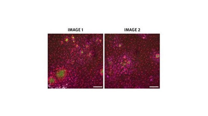 Image 1 shows brain cells from a mouse cortex that didn't receive the gene therapy. The amyloid plaques are shown in green, and the glial cells, which surround the plaques, are shown in red (microglia) and magenta (astrocytes). Image 2 shows a mouse cortex that received the gene therapy, and so had fewer amyloid plaques. Credit Imperial College London