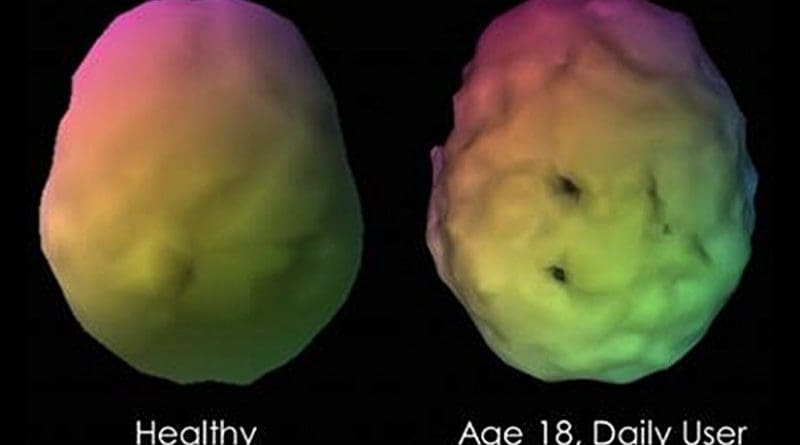 This shows a sample case of a visual 3-D rendering of a baseline SPECT scan of a longstanding marijuana user compared to a control subject. The marijuana user has multiple perfusion defects with lower perfusion shown as scalloping and gaps in perfusion of the temporal and parietal areas. Credit Journal of Alzheimer's Disease