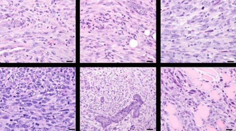 Mammary tumors caused by deleting CCN6 look like metaplastic carcinoma. Credit University of Michigan Health System