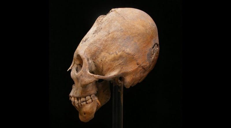 A modified skull from Gy?r. The practice of modification originated in central Asia and has been associated with Huns and other nomadic populations. Credit Erzsébet Fóthi, Hungarian Natural History Museum Budapest