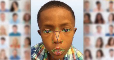 A young boy undergoes facial recognition software for a possible diagnosis with DiGeorge syndrome, a rare disease. Credit Paul Kruszka, et al.