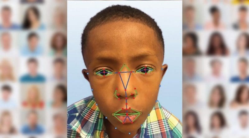 A young boy undergoes facial recognition software for a possible diagnosis with DiGeorge syndrome, a rare disease. Credit Paul Kruszka, et al.