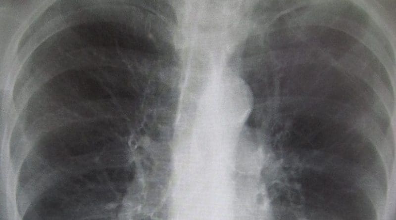 Chest X-ray demonstrating severe COPD. Note the small heart size in comparison to the lungs. Photo by James Heilman, MD, Wikipedia Commons.