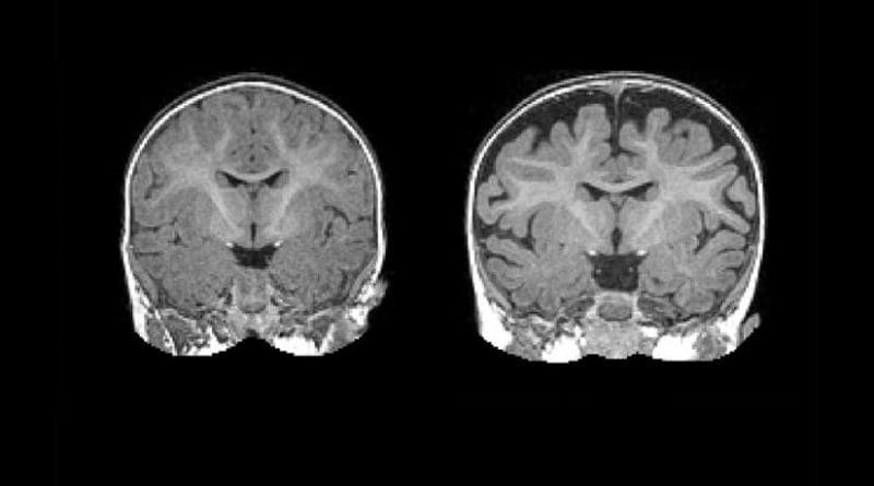 Right: MRI of a baby at 6 months who was diagnosed with autism at 2 years. The dark space between the brain folds and skull indicate increased amounts of cerebrospinal fluid. Left: MRI of a baby who was not diagnosed with autism at age 2. Note the decreased amount of CSF. Credit Carolina Institute for Developmental Disabilities (UNC-Chapel Hill)