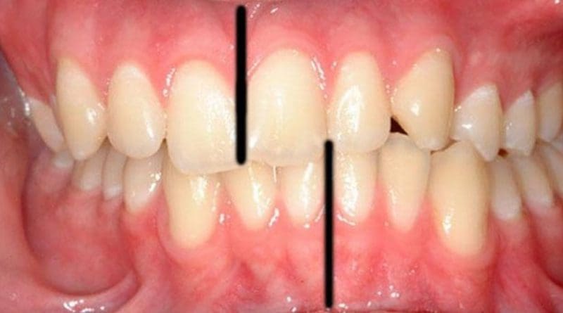 This is an example of a crooked bite which led to a large shift between the midlines (black lines added to image) of the upper and lower incisors. Credit Courtesy of Philippe Hujoel
