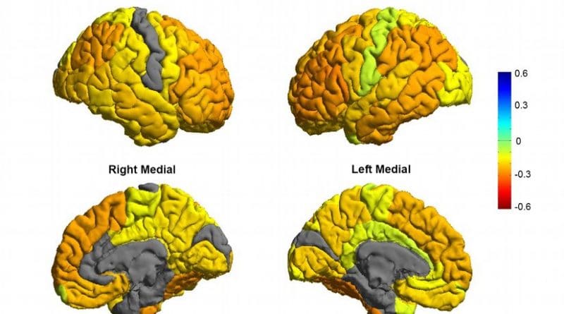 Bipolar patients tend to have gray matter reductions in frontal brain regions involved in self-control (orange colors), while sensory and visual regions are normal (gray colors). Credit Image courtesy of the ENIGMA Bipolar Consortium/Derrek Hibar et al.