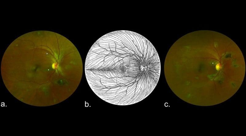 These are composite scanning laser ophthalmoscope retinal images showing type 6 Ebola peripapillary or peripheral lesions, observed following the anatomic distribution of the ganglion cell axon (retinal nerve fiber layer), in a case-control study of ocular signs in Ebola virus disease survivors, Sierra Leone, 2016. A) Example 1, right eye. B) Illustration of the ganglion cell axon anatomic distribution. Courtesy of W.L.M. Alward. C) Example 2, right eye. Asterisks indicate curvilinear lesions distinct from the retinal vasculature. White arrowhead indicates retinal nerve fiber wedge defect. Credit University of Liverpool