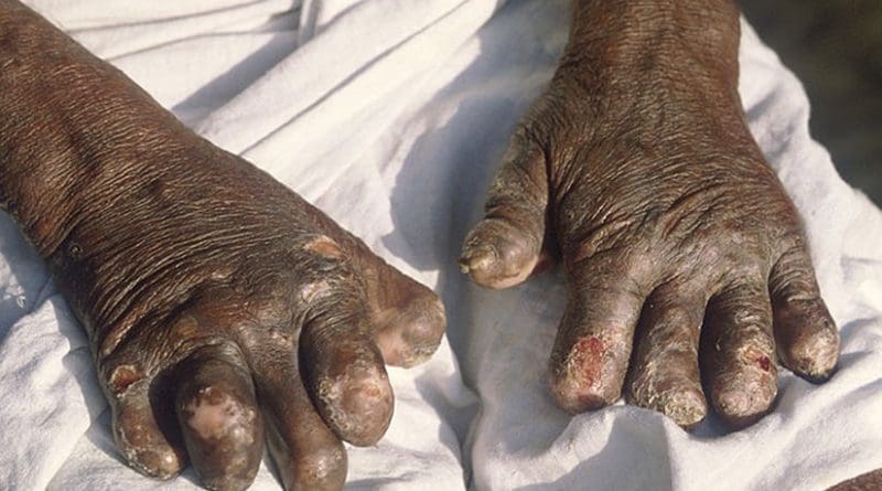 Hands deformed by leprosy. Photo by B.jehle, Wikipedia Commons.
