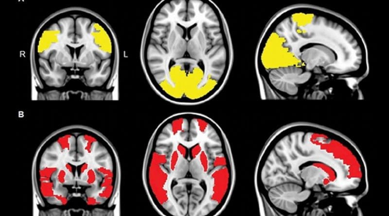 MR images show reduced regional functional connectivity in, A, Parkinson's disease (PD) patients and, B, exclusively in PD + visual hallucinations (VH) patients. Regional functional connectivity analysis revealed lower functional connectivity in PD + VH as well as PD - VH patients compared with control participants in paracentral and occipital regions (yellow areas in A; P < .05, corrected for multiple comparisons). Functional connectivity in frontal, temporal, and subcortical regions was exclusively lower in patients with PD + VH compared with control participants (red areas in B; P < .05, corrected for multiple comparisons). Credit Radiological Society of North America