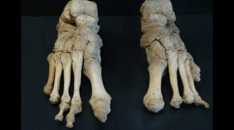 These are feet bones, severely affected by leprosy, from the Om Kloster museum in northern Jutland Denmark. Credit Saige Kelmelis