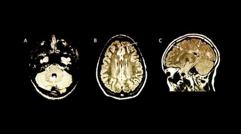 Arrows indicate abnormalities on MRI brain scans in children with no symptoms of multiple sclerosis. Credit Yale University