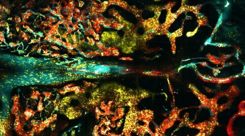 Healthy bone marrow (yellow) invaded by leukaemia, with blood vessels in cyan (red). Credit Delfim Duarte/Imperial College London