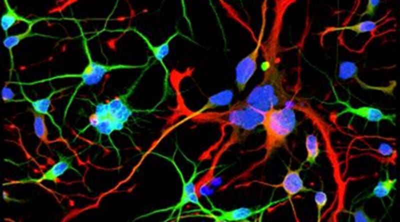 Huntington's neurons show signs of trouble, like multiple nuclei (blue) within the same cell, long before symptoms emerge. Credit Laboratory of Stem Cell Biology and Molecular Embryology at The Rockefeller University
