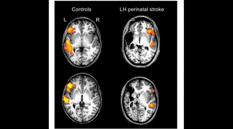 These are individual scans of two healthy controls and two individuals with a left-hemisphere (LH) perinatal stroke. The orange/yellow activation shows the normal language areas of the left hemisphere in healthy individuals, as compared with the reorganized language areas in individuals with a left-hemisphere perinatal stroke. Credit Elissa Newport