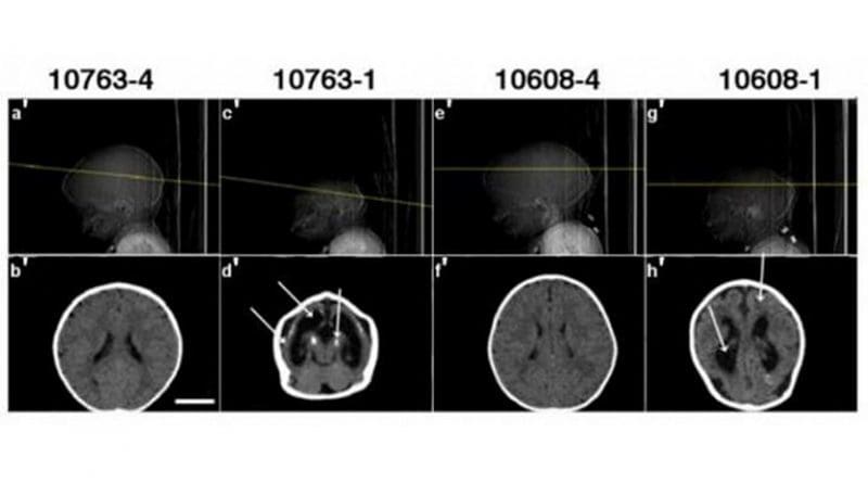 Computed tomography scans from two pairs of twins participant in the study show typical abnormalities (second and forth images) associated with congenital Zika syndrome and microcephaly. Credit HUG-Cell