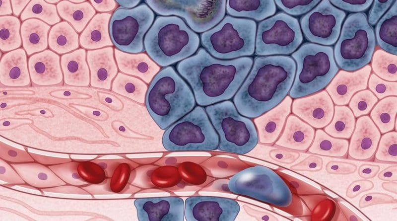 Growing cancer cells (in purple) are surrounded by healthy cells (in pink), illustrating a primary tumor spreading to other parts of the body through the circulatory system. Credit Darryl Leja, NHGRI