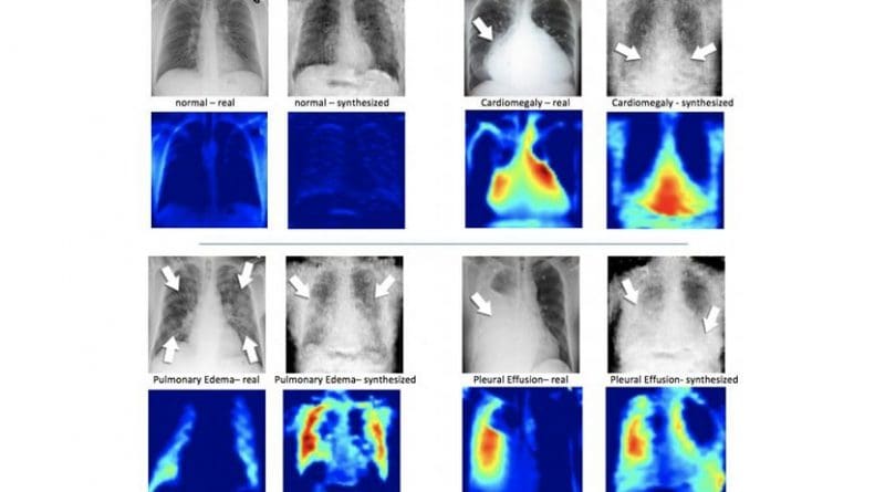 On the left of each quadrant is a real X-ray image of a patient's chest and beside it, the syntheisized X-ray formulated by the DCGAN. Under the X-ray images are corresponding heatmaps, which is how the machine learning system sees the images. Credit Hojjat Salehinejad/MIMLab