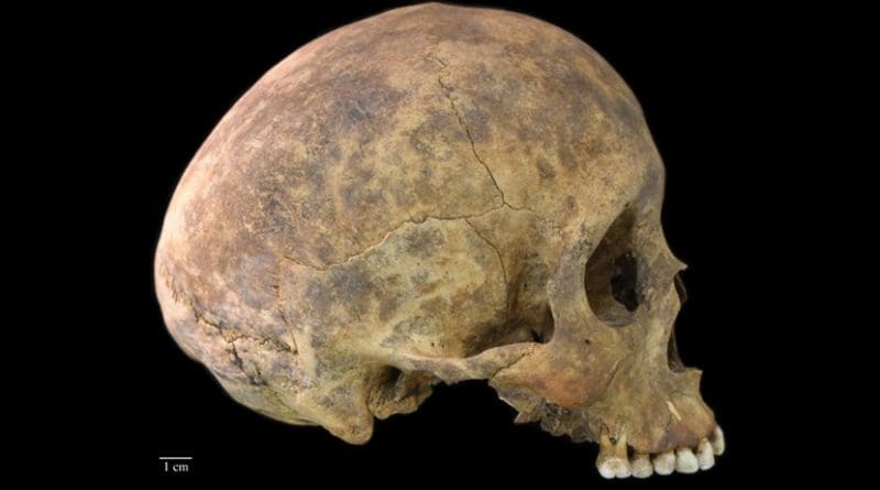 One of two cases of healed blows to the cranium from the Playa Venado excavations. Most of the evidence of violence was interpreted by Harvard archaeologist, Samuel Lothrop based on body positioning in graves at the site. Smithsonian post-doctoral fellow, Nicole Smith-Guzmán, found no examples of trauma that occurred near the time of death among the skeletons in the collection. Credit Nicole Smith-Guzmán, STRI