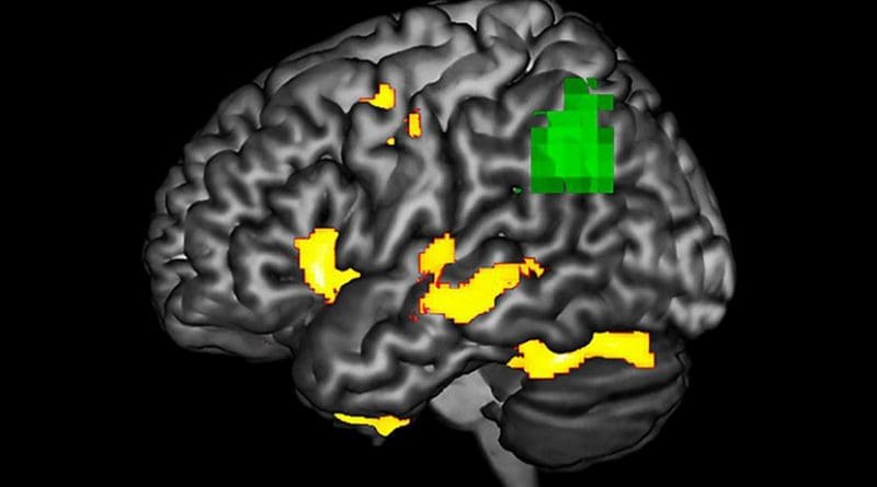 This image highlights areas in a PPA-affected brain during a language task where researchers observe functional abnormality (green) and structural degenerating (yellow). The green areas may be at-risk or dysfunctional, even if the neurons are not dead yet. (Courtesy: Aneta Kielar) Credit Aneta Kielar