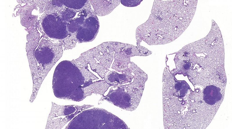 Image of lung cancer shows normal lung (light purple) and tumors (dark purple). Inactivation of SIK1 and SIK3 leads to tumor growth and inflammation, revealing for the first time that SIK kinases mediate key functions of LKB1 in preventing lung cancer. Credit Salk Institute