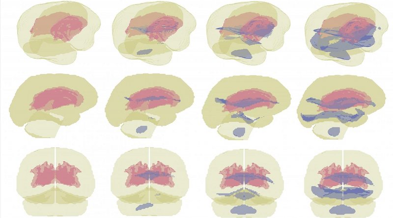 During a side hit to the head, deep white matter (pink) and structures near the corpus callosum (purple) are most vulnerable to injury. Credit Stevens Institute of Technology