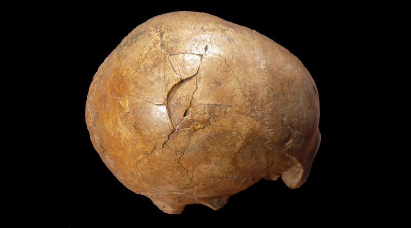 Right lateral view of the Cioclovina calvaria exhibiting a large depressed fracture. Credit Kranoti et al, 2019