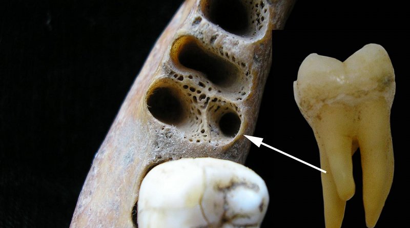 The three-rooted lower molar anomaly in a recent Asian individual. Left: tooth sockets showing position of accessory root; right: three-rooted lower first molar tooth. Credit Christine Lee