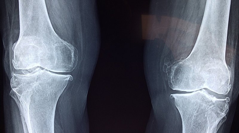 knees x-ray medical bone