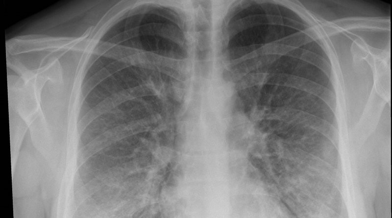 This chest x-ray of a patient being treated for e-cigarette or vaping-associated lung injury shows lung opacities, densities and whitish cloud-like areas which are typically seen with unusual pneumonias, fluid in lungs or lung inflammation. CREDIT Intermountain Healthcare