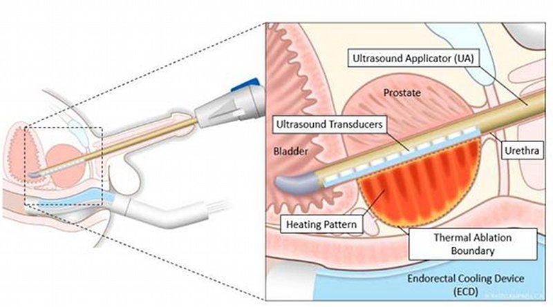 This diagram shows controlled and precise ablation using TULSA-PRO®. CREDIT Study author and RSNA