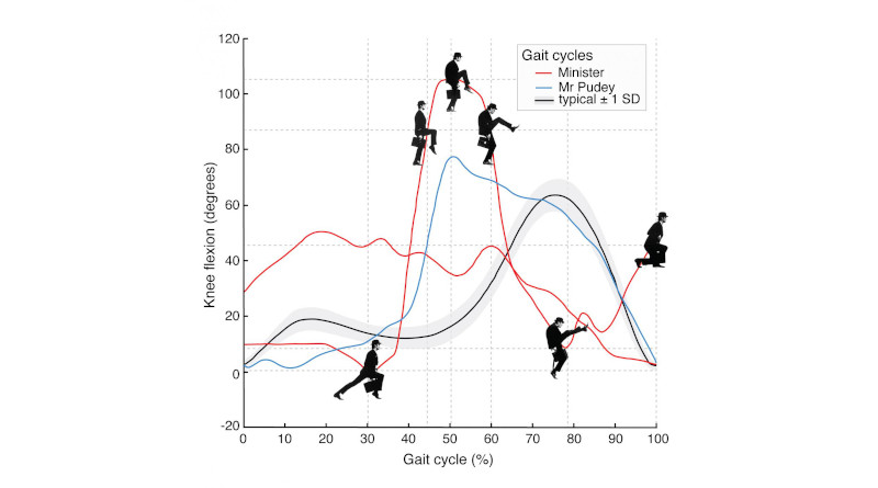 Monty Python's 'Ministry of Silly Walks': Comparison of two complete gait cycles of the Minister, one of Mr. Pudey and the mean curve for people without pathology. (Data source: Motion & Gait Analysis Laboratory, Lucile Packard Children's Hospital at Stanford). Left knee flexion in the sagittal plan of motion normalized to a single gait cycle. (Two gait cycles of the Minister are from the televised sketch, which premiered Sept. 15, 1970 and the live stage performance in Los Angeles, Calif, in Sept. 1980 [video source: the 1982 concert film Monty Python Live at the Hollywood Bowl]. Gait cycle of Mr. Pudey is from the original sketch). CREDIT Chart created by Erin E. Butler and Nathaniel J. Dominy.