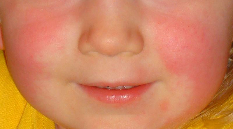 Red cheeks and pale area around the mouth in scarlet fever. Photo Credit: Estreya, Wikipedia Commons.