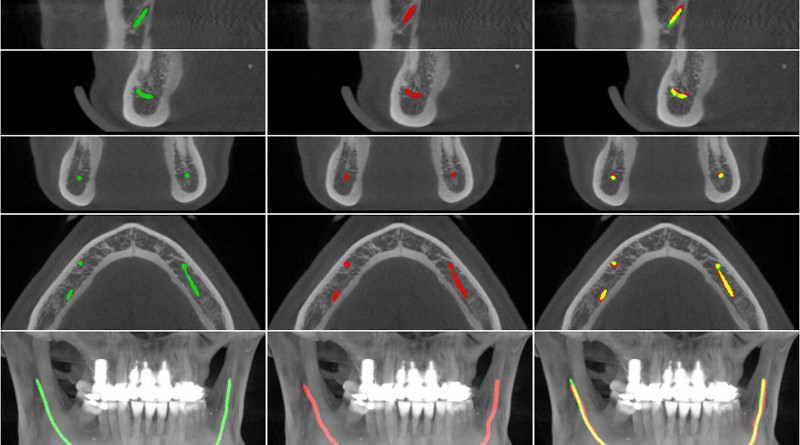 Comparison of the model segmentation and the ground truth, from the secondary test data annotations, for a CBCT scan. For further explanation, see the research article in Scientific Reports. CREDIT The authors