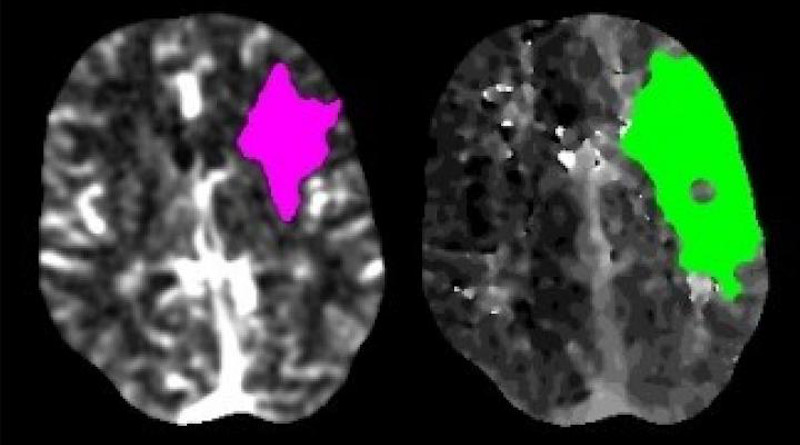 Scans of a stroke patient's brain show the area where tissue has died (magenta) and where tissue is damaged but may still be saved with prompt intervention (green). A study from Washington University School of Medicine in St. Louis has found that stroke evaluations fell by nearly 40% during a period of the COVID-19 pandemic, suggesting that many stroke patients are not seeking potentially life-saving medical treatment. CREDIT: Akash Kansagra