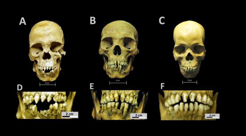 Skulls and dental decoration patterns for the three African individuals from the San José de los Naturales Royal Hospital. A. Skull from individual 150 (SJN001). B. Skull from individual 214 (SJN002). C. Skull from individual 296 (SJN003). D. Close-up of dental modification patterns for individual 150 (SJN001). E. Close-up of dental modification patterns for individual 214 (SJN002). F. Close-up of dental modification patterns for individual 296 (SJN003). CREDIT Collection of San José de los Naturales, Osteology Laboratory, (ENAH), Mexico City, Mexico. Photo: R. Barquera & N. Bernal.