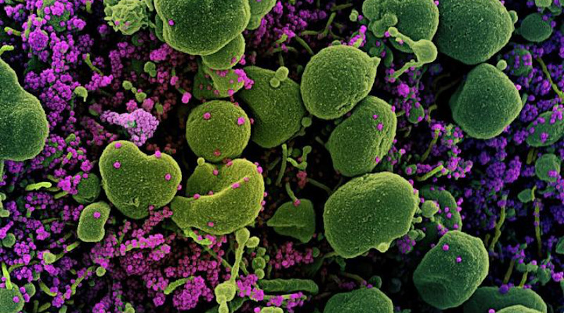 Colorized scanning electron micrograph of an apoptotic cell (green) heavily infected with SARS-COV-2 virus particles (purple), isolated from a patient sample. Image captured at the NIAID Integrated Research Facility (IRF) in Fort Detrick, Maryland. CREDIT: NIAID