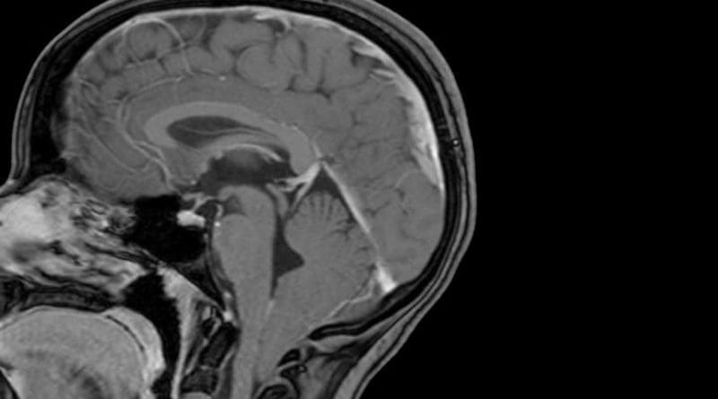 The lowest part of a child's brain is visible below the bottom of the skull in this MRI scan and shows evidence of a Chiari 1 malformation. Researchers at Washington University School of Medicine in St. Louis have shown that Chiari 1 malformation can be caused by variations in two genes linked to brain development, and that children with large heads are at increased risk of developing the condition. CREDIT David Limbrick