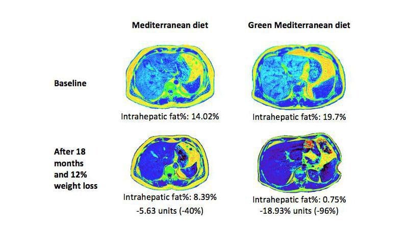 MRI photos illustrate the green MED diet effect on hepatic fat loss A green Mediterranean (MED) diet reduces intrahepatic fat more than other healthy diets and cuts non-alcoholic fatty liver disease (NAFLD) in half, according to a long-term clinical intervention trial led by Ben-Gurion University of the Negev researchers and a team of international colleagues. CREDIT Gut 2021