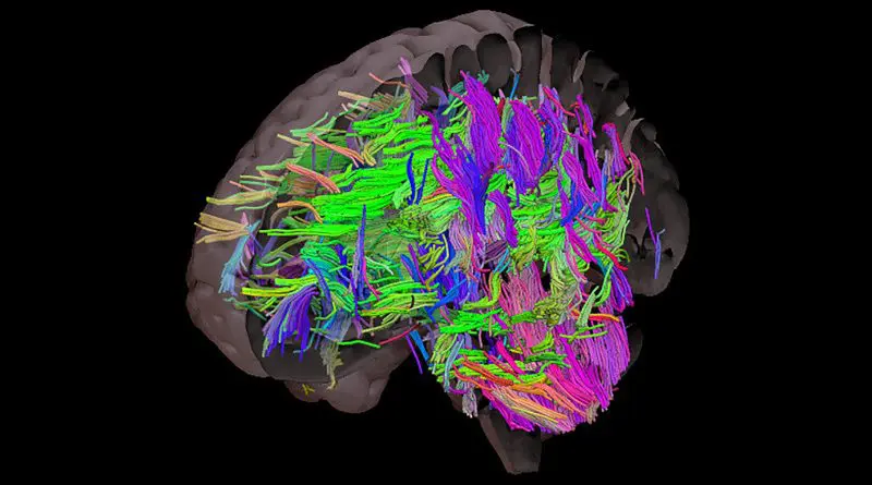 The brain with all the white matter tracts visible. White matter tracts are susceptible to damage in people with uncontrolled cardiovascular risks like obesity. CREDIT The University of Sheffield