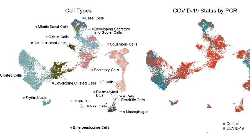 These maps represent gene expression in cells recovered from COVID-19 test swabs, based on single-cell RNA sequencing of more than 32,000 cells from 58 people. Each point in the maps represents an individual cell. At left, cell types from the nasopharynx are color-coded and arranged such that those with similar patterns of gene expression are in closer proximity. At right, red and blue colors indicate cell types that are enriched in COVID-19 (shown in red) and in healthy controls (blue). CREDIT: BioRxiv Feb 20, 2021, https://doi.org/10.1101/2021.02.20.431155