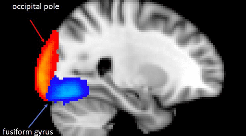Illustration: fMRI (functional Magnetic Resonance Image) of brain showing the location of areas of reduced activity. CREDIT: Liliana Capitão